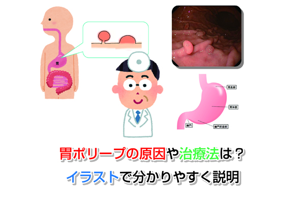 Cause of stomach polyps Eye-catching image