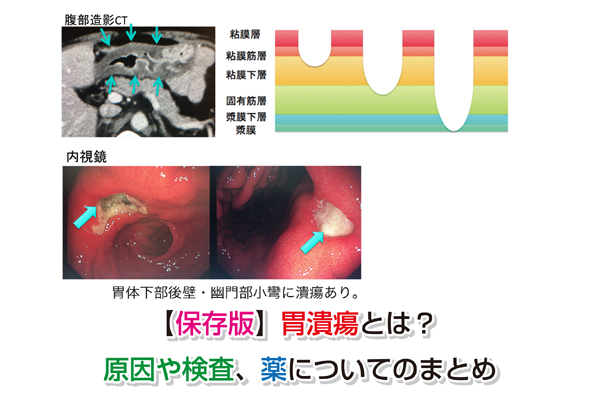 Gastric ulcer Eye-catching image
