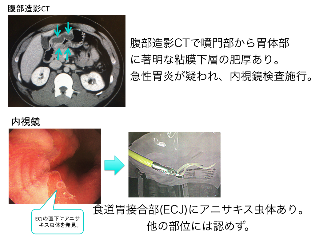 acute-gastric-mucosal-lesion-001