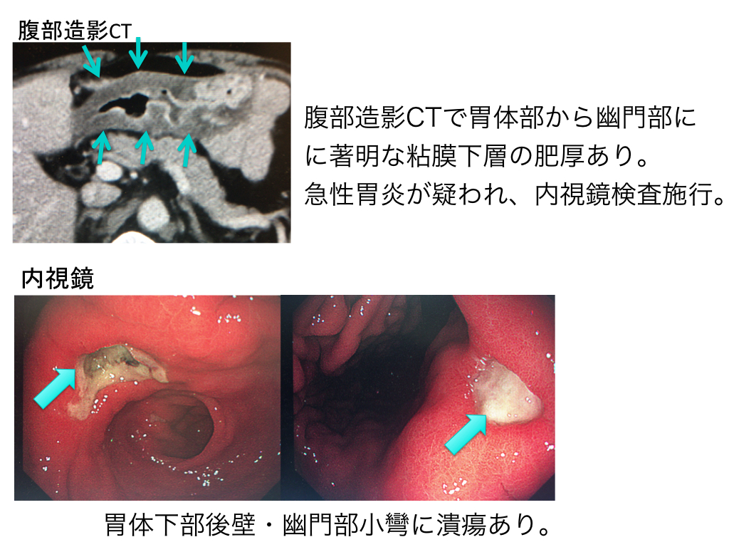 acute-gastric-mucosal-lesion-002