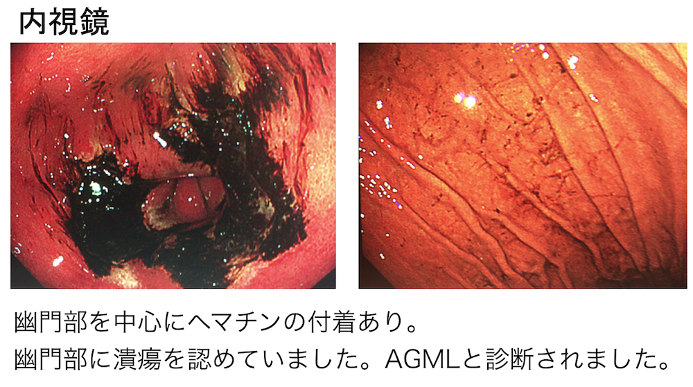 acute-gastric-mucosal-lesion