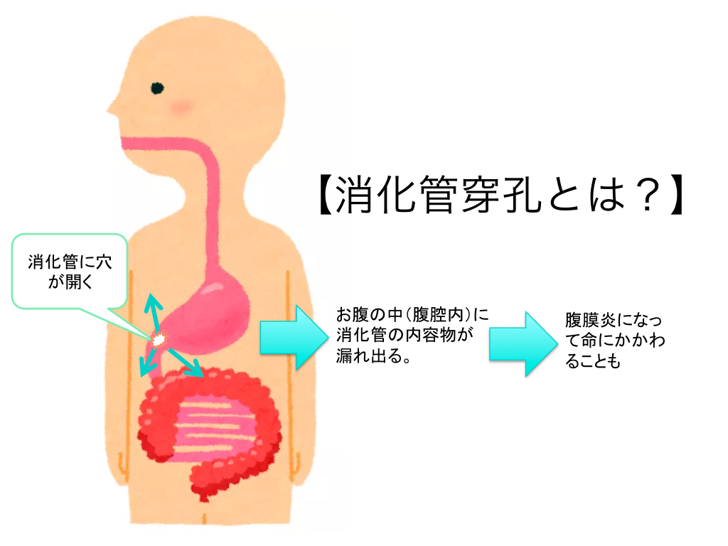 intestinal-perforation-001