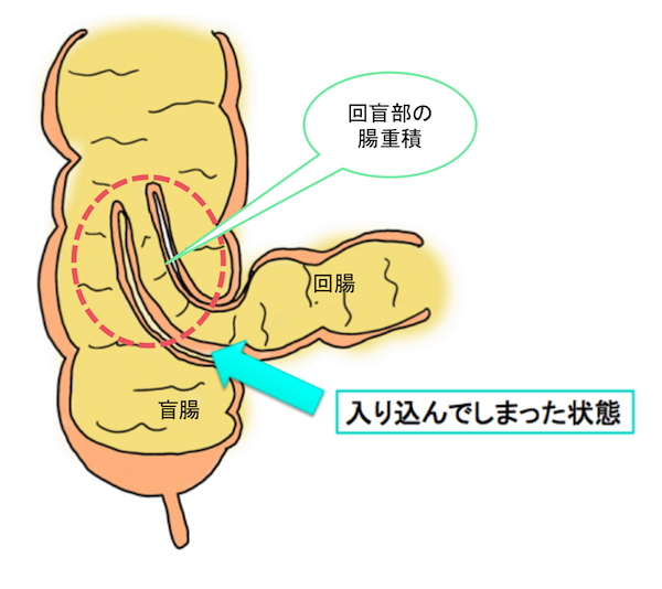 intussusception1