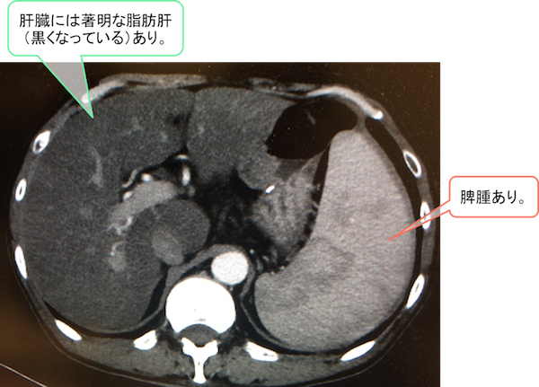 Alcoholic liver injury fatty liver ct findings