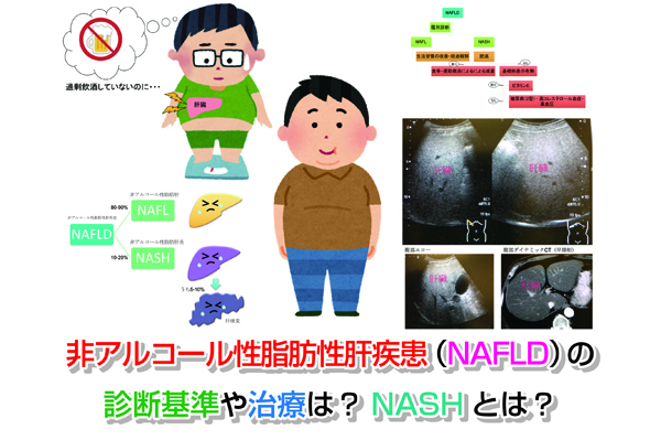 【画像あり】非アルコール性脂肪性肝疾患（NAFLD）の診断基準や治療は？NASHとは？