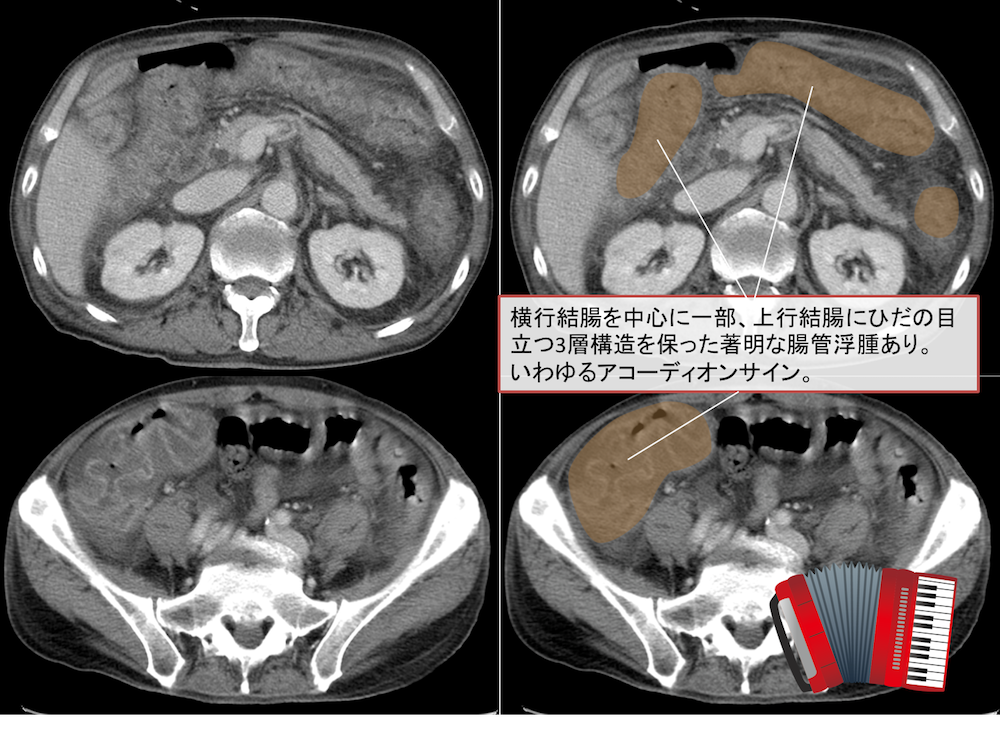 pseudomembranous-colitis-ct-findings