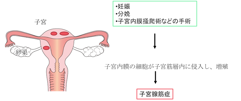 uterine-adenomyosis-figure1