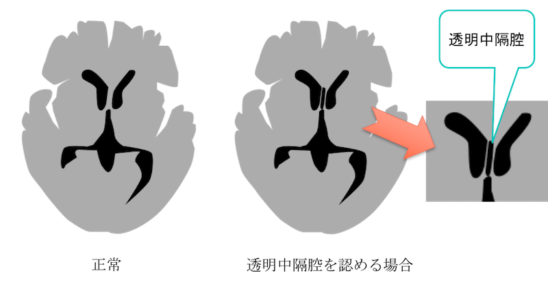 avus septum pellucidum figure