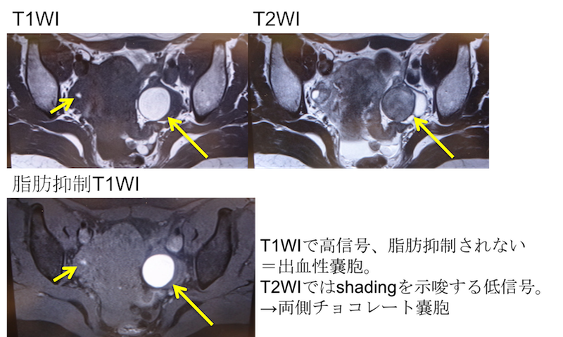 chocolate-cyst-of-the-ovary-mri-findings