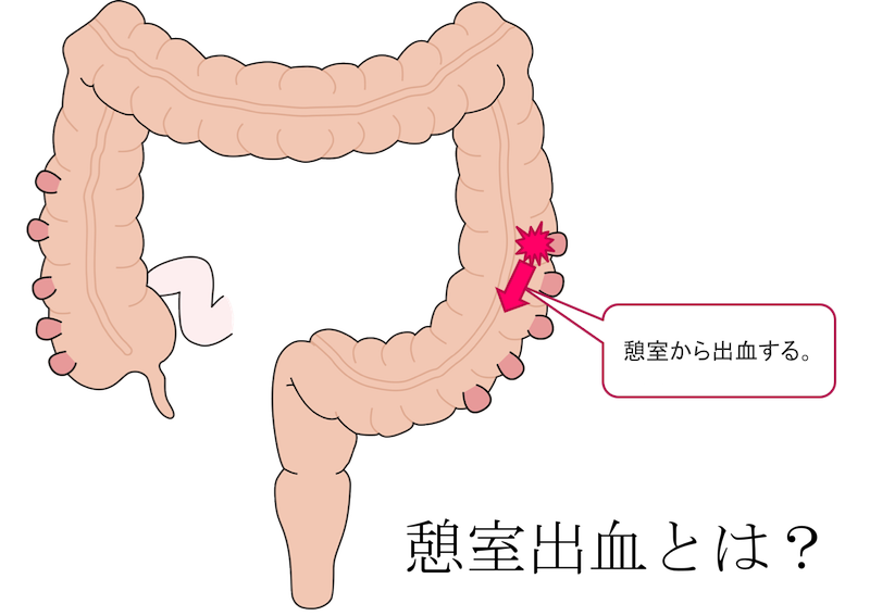 colon-diverticulus-hemorrhage