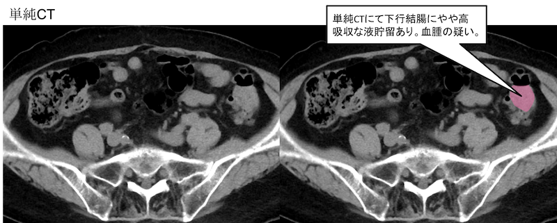 colonic-diverticular-hemorrhage-ct-findings1