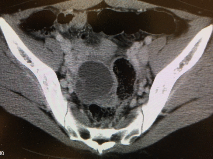 endometrial cyst CT MRI findigs1