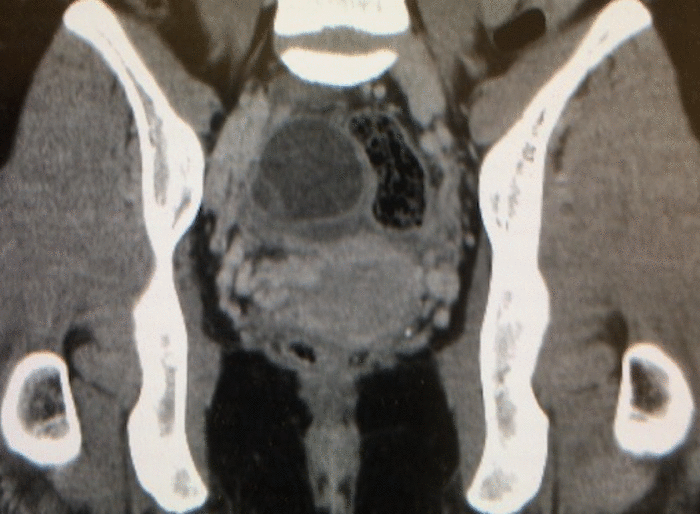 endometrial cyst CT MRI findigs2
