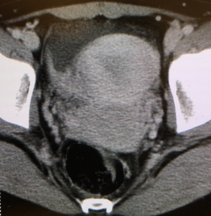 endometrial cyst CT MRI findigs3
