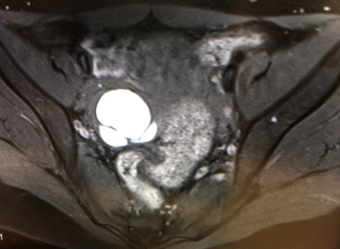 endometrial cyst CT MRI findigs4