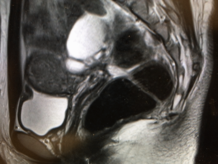 endometrial cyst CT MRI findigs5