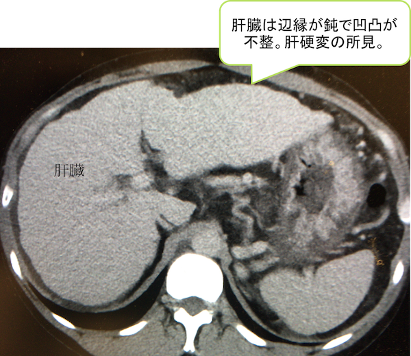 liver cirrhosis CT findings