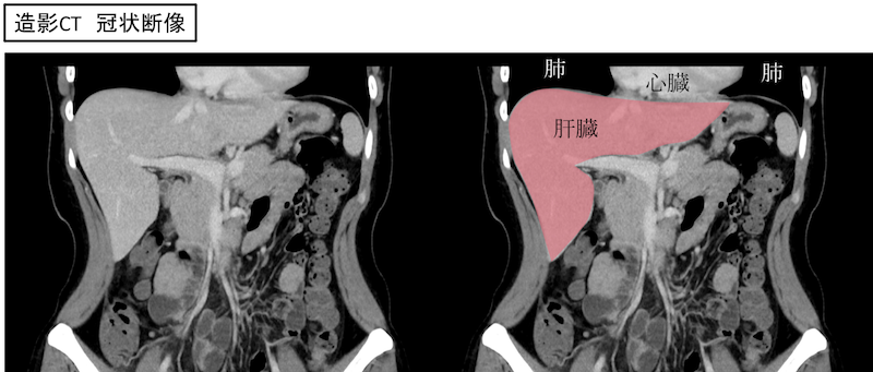 liver location anatomy CT coronal findings