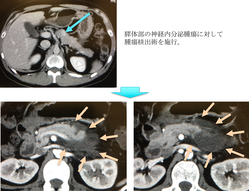 pancreatic fistula CT findings1