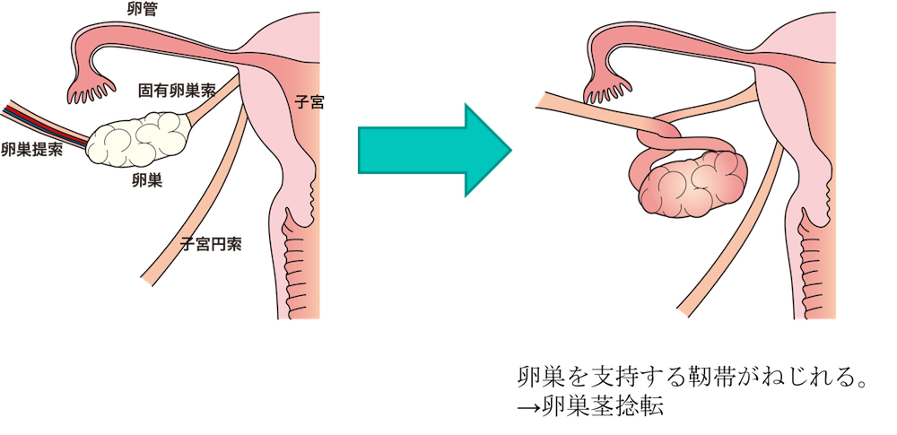 torsion of ovarian pedicle figure