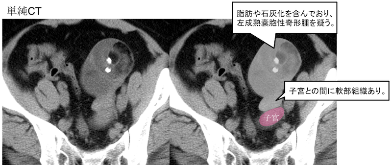 torsion of ovarian tumor pedicle CT findings1