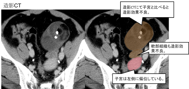 torsion of ovarian tumor pedicle CT findings2