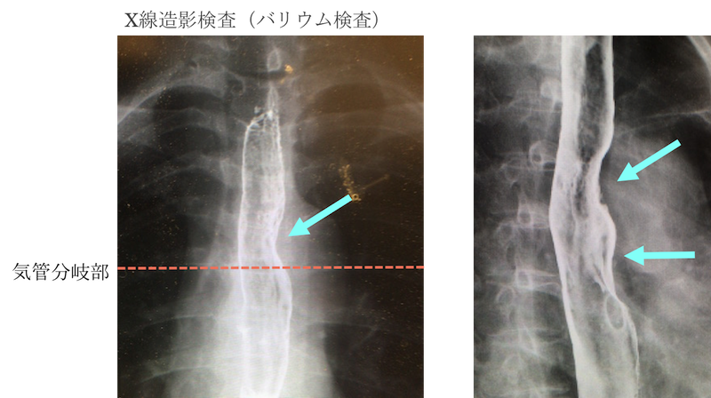 Esophageal cancer Xray findings