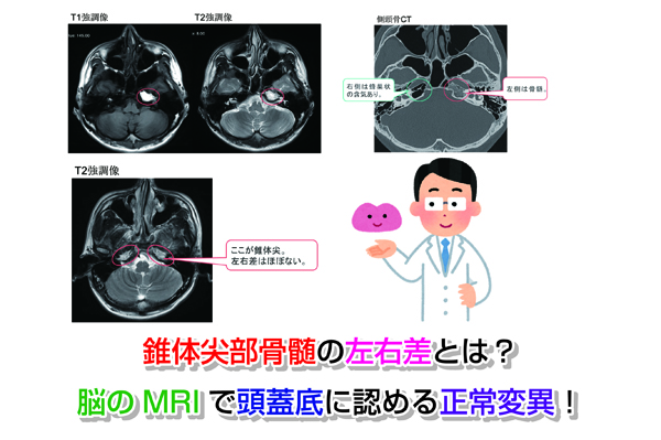 錐体尖部骨髄の左右差とは？脳のMRIで頭蓋底に認める正常変異！