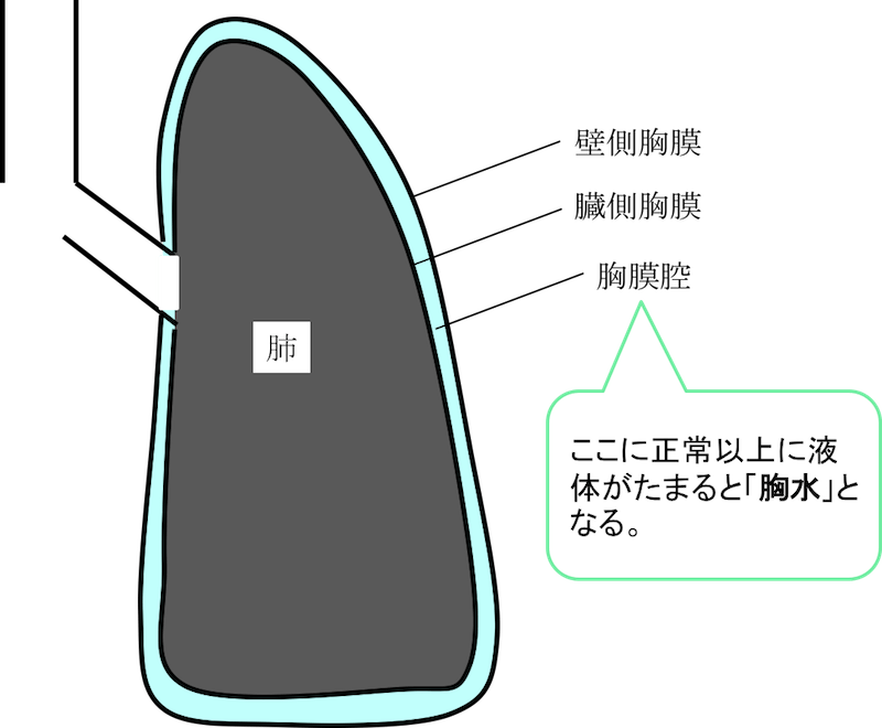 Pleural-effusion