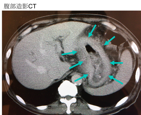 Scirrhous gastric cancer CT findings