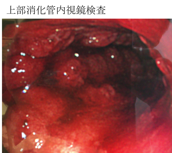 Scirrhous gastric cancer endscope findings