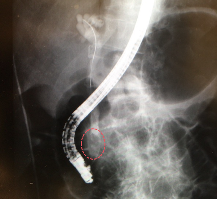 ERCP for CBD stone