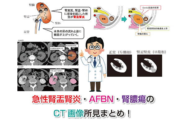 急性腎盂腎炎・AFBN・腎膿瘍のCT画像所見まとめ！