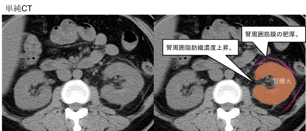 Pyelonephritis CT findings2