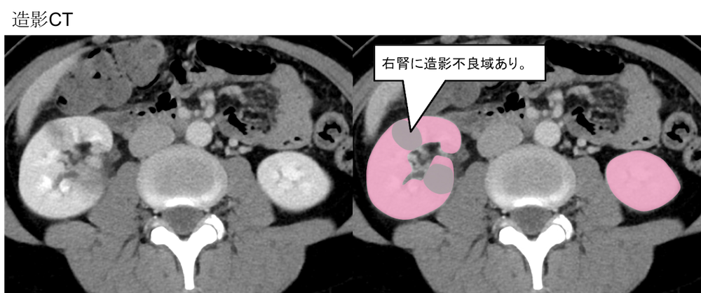 Pyelonephritis CT findings4