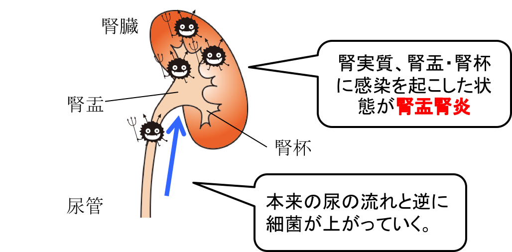 Pyelonephritis figure1