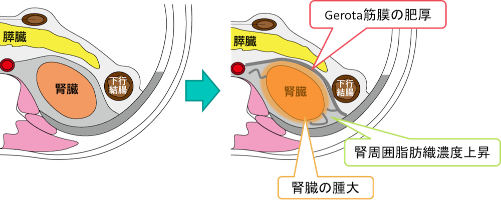 Pyelonephritis figure2