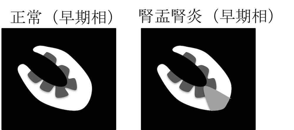 Pyelonephritis figure3