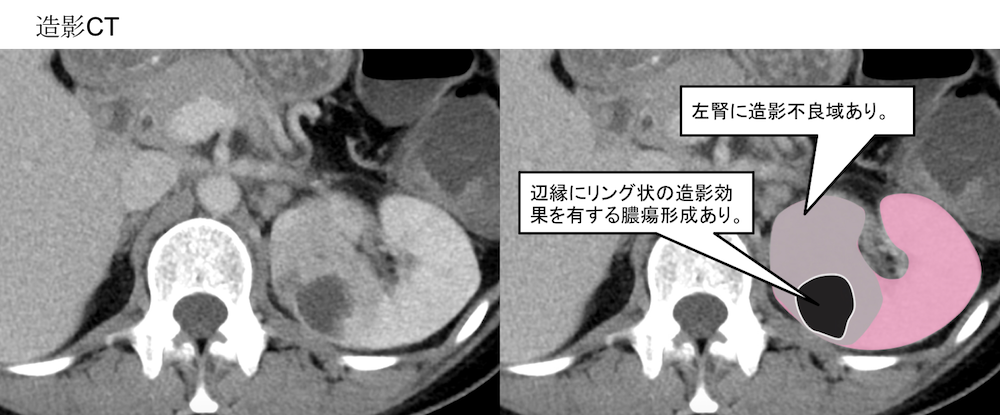 Pyelonephritis renal abscess CT findings4