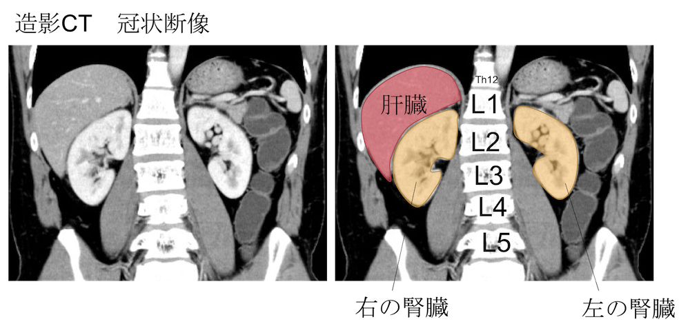 height of kidney ct findings