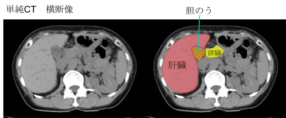 location of gallbladder CT findings1