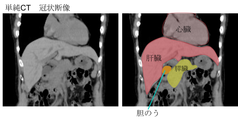 location of gallbladder CT findings2
