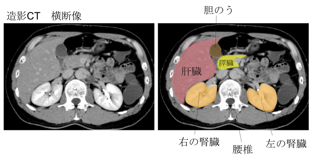 place of kidney ct findings