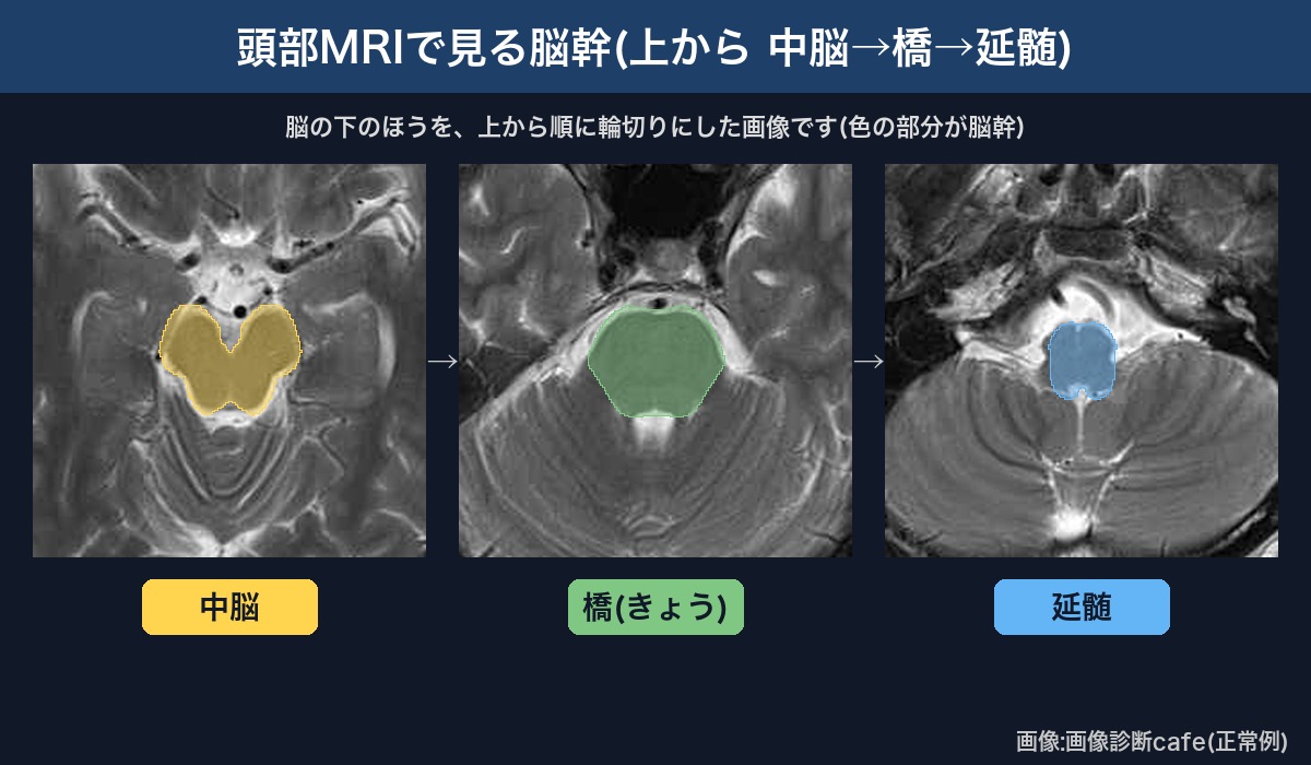 頭部MRI(画像診断cafe正常例)で見る脳幹(中脳・橋・延髄)