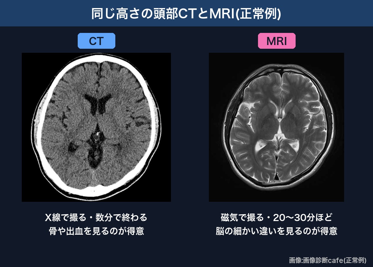 同じ高さの頭部CTと頭部MRI(画像診断cafeの正常例)の比較