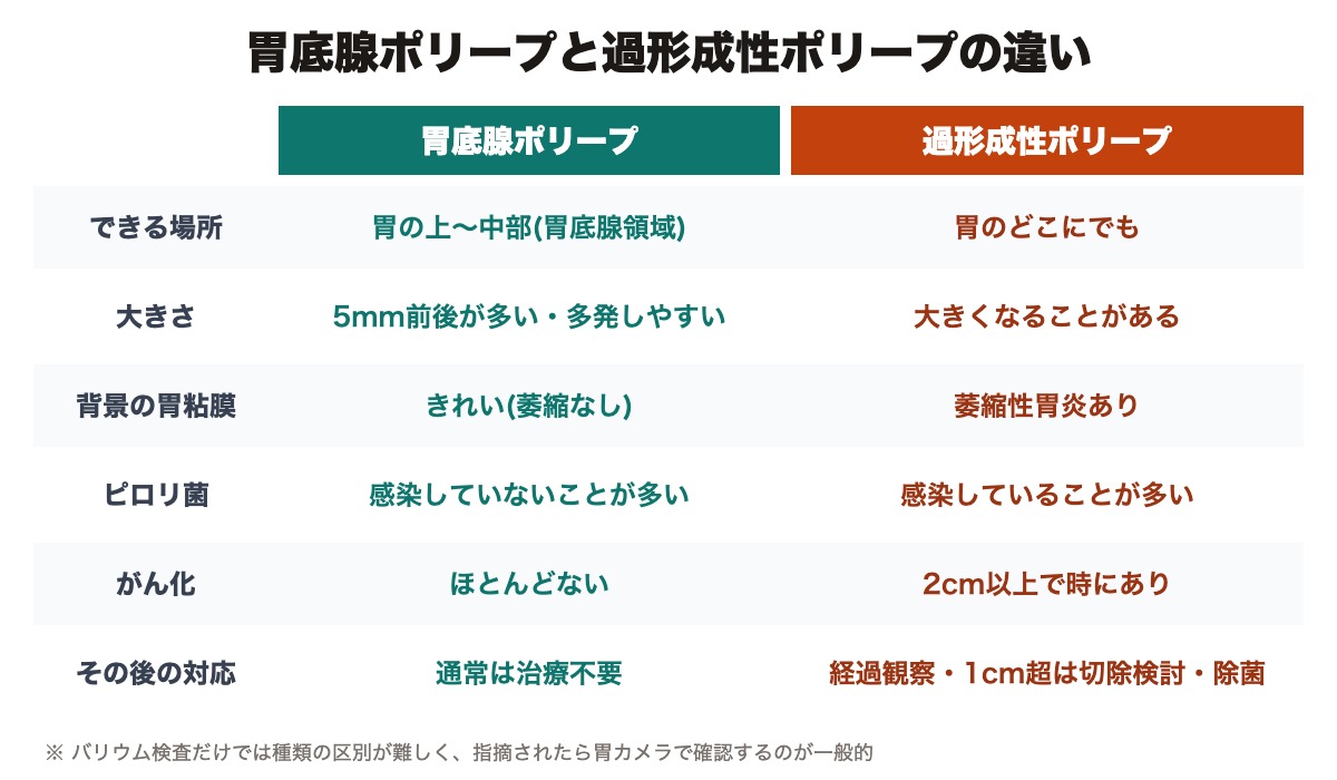 胃底腺ポリープと過形成性ポリープの違い(場所・大きさ・ピロリ菌・がん化・対応)
