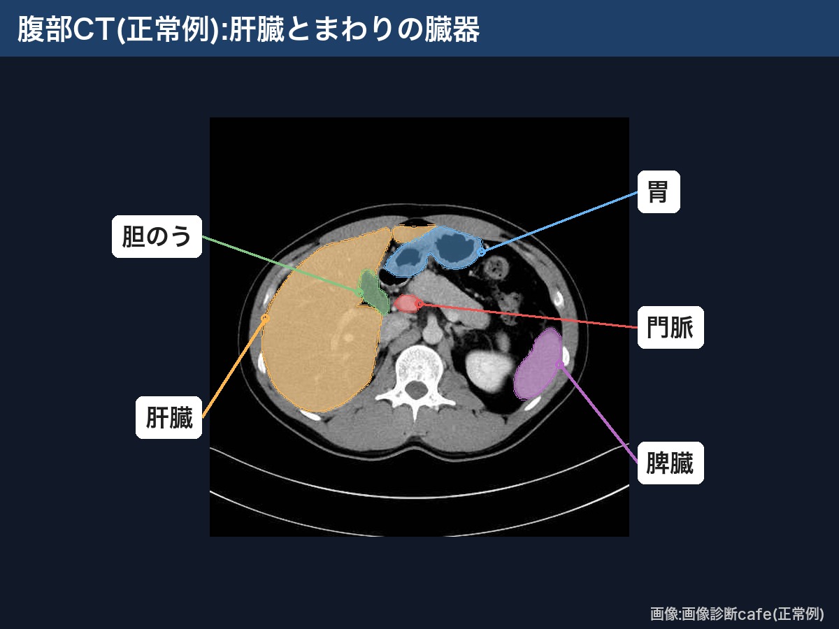 腹部CT(画像診断cafe正常例):肝臓・胆のう・門脈・胃・脾臓