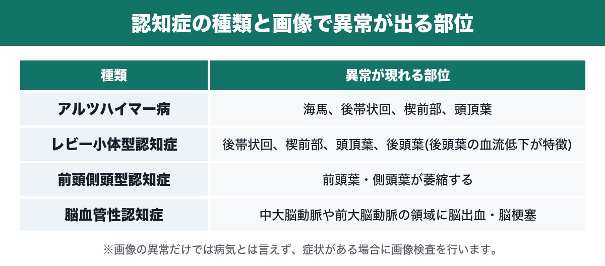 認知症の種類と画像で異常が出る部位の表