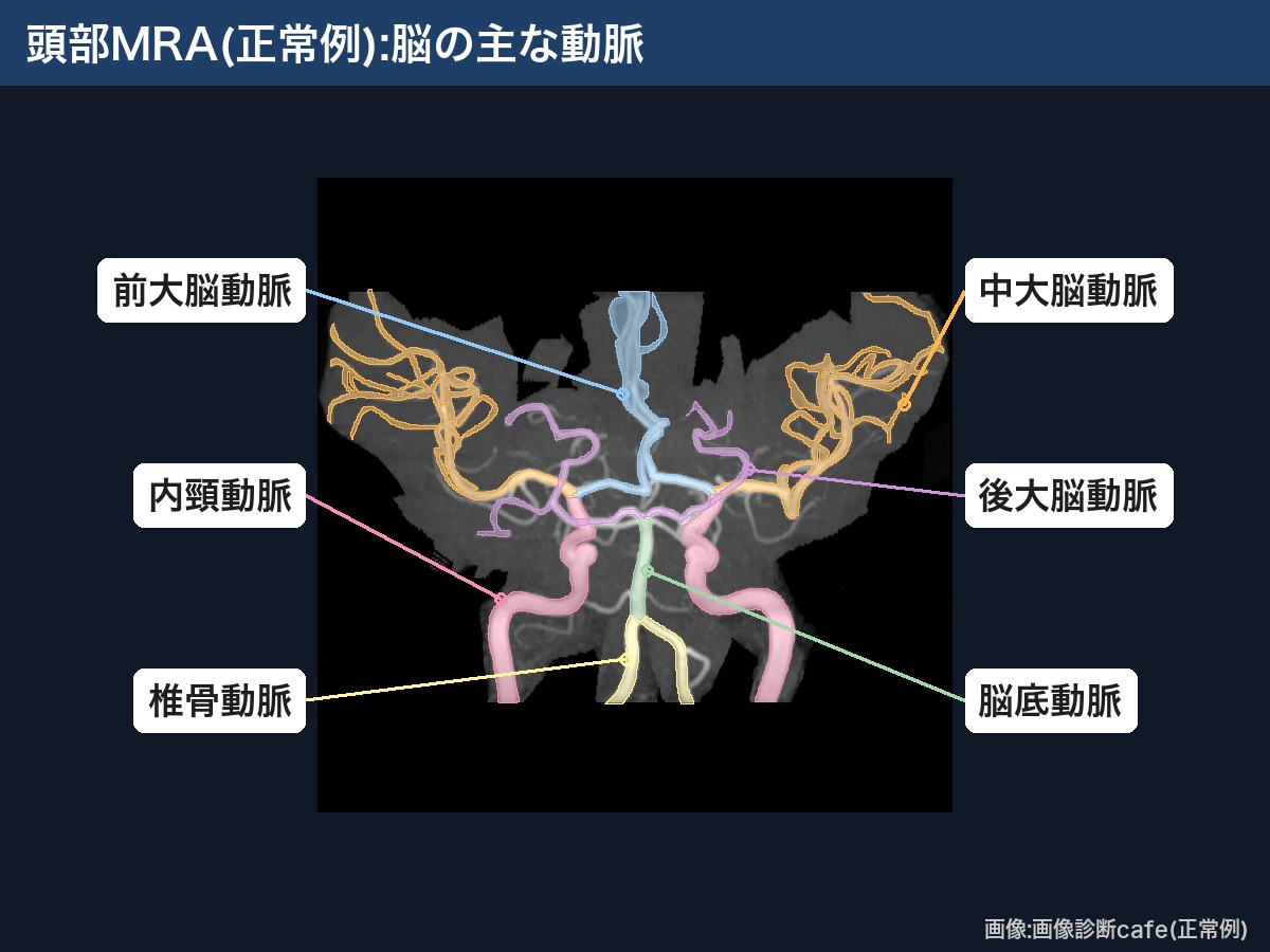 頭部MRA(正面・画像診断cafe正常例):内頸動脈・前大脳動脈・中大脳動脈・後大脳動脈・脳底動脈・椎骨動脈