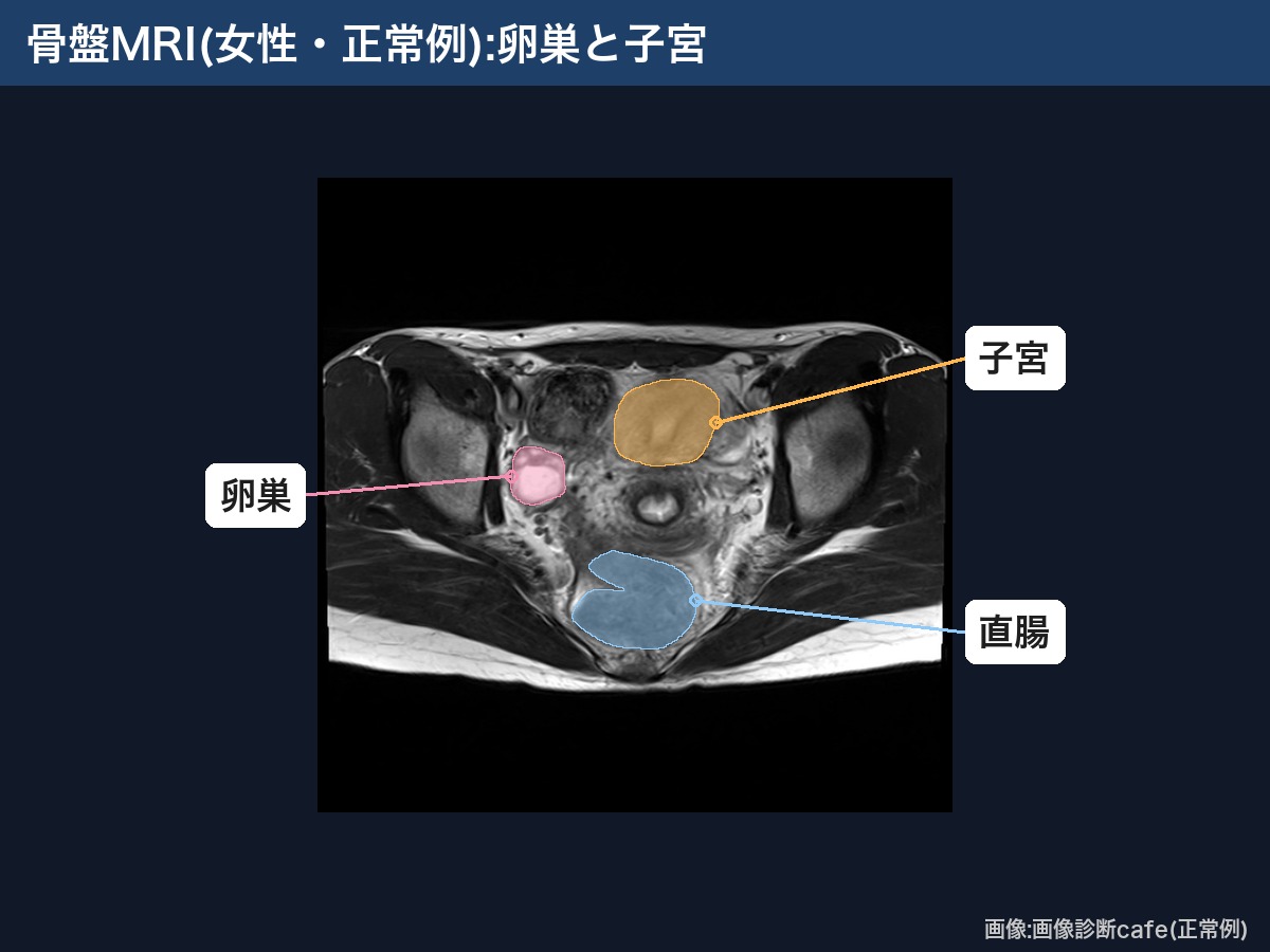 骨盤MRI(画像診断cafe女性正常例):卵巣・子宮・直腸